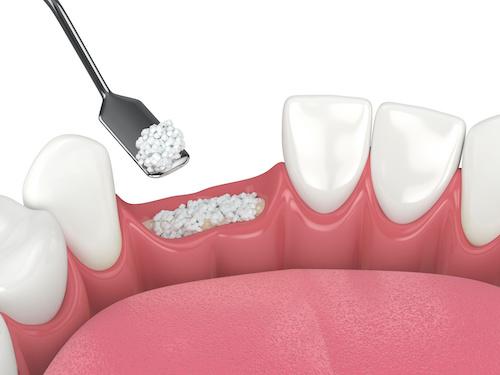 raleigh dental implants