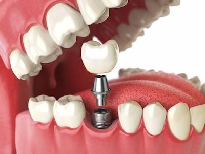 dental implants in raleigh nc