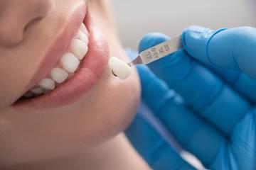 veneers in raleigh
