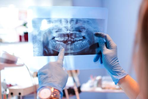 bone grafting raleigh nc