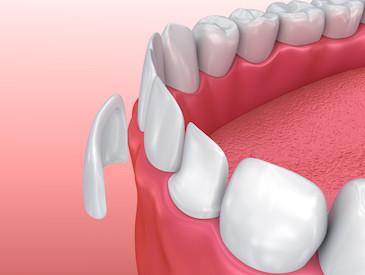 porcelain veneers raleigh nc