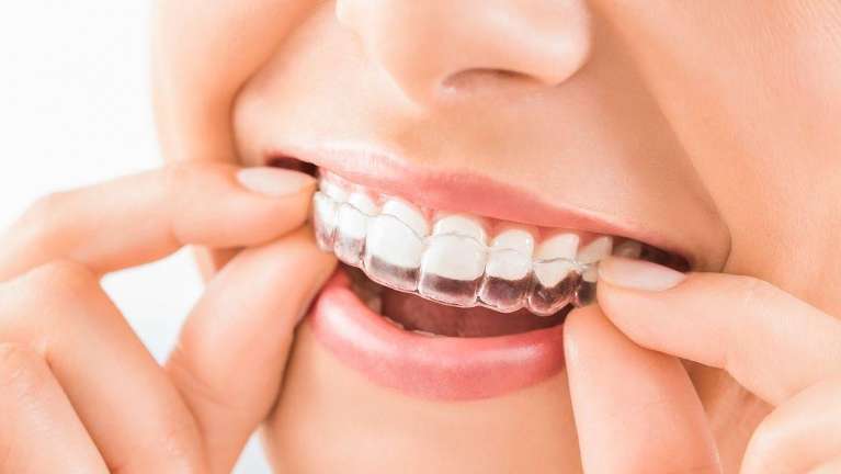 woman putting on suresmile clear braces in raleigh nc