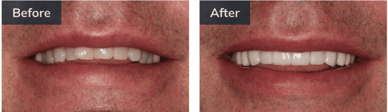 smile makeover before and after pictures