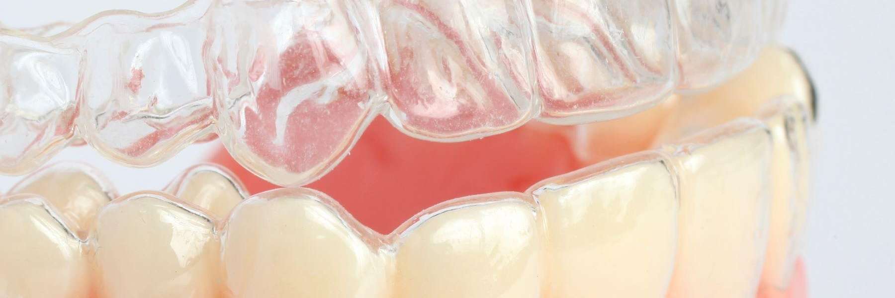 Clear aligners in raleigh nc