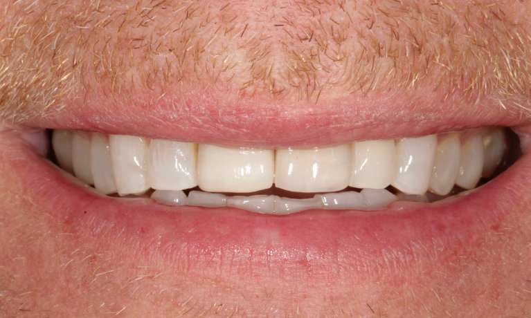 Dental-Implant-Crown-After-Image