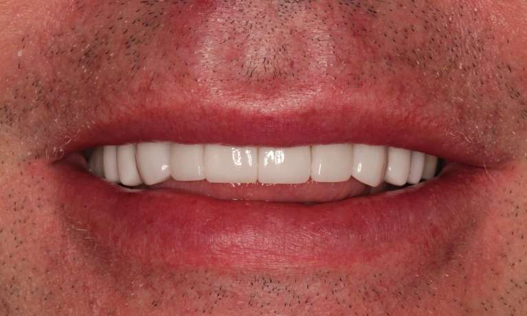 full smile makeover in raleigh nc