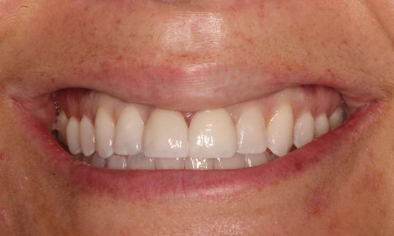 internal bleaching and veneers use to improve front teeth