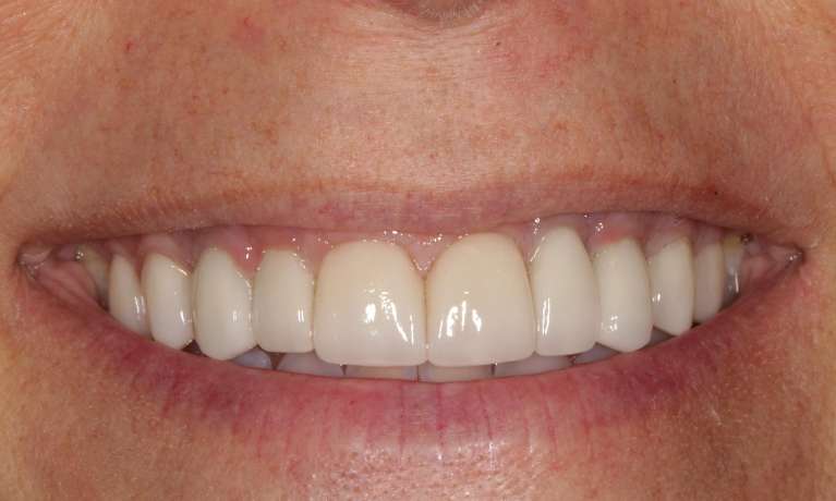 new smile using implants, veneers, and crowns