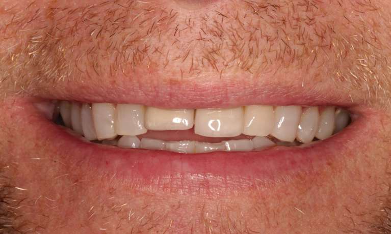 Dental-Implant-Crown-Before-Image
