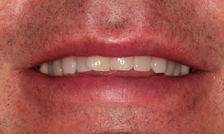 smile makeover raleigh nc