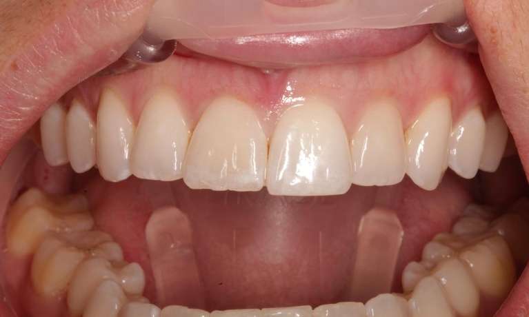 misshapen and discolored front teeth