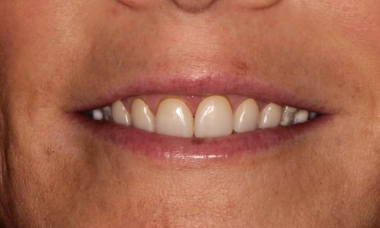 dental veneers raleigh nc