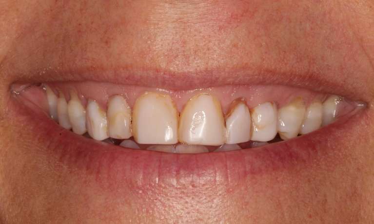 close up of woman's smile with existing baby teeth