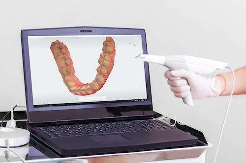 digital impressions at dentist in raleigh nc